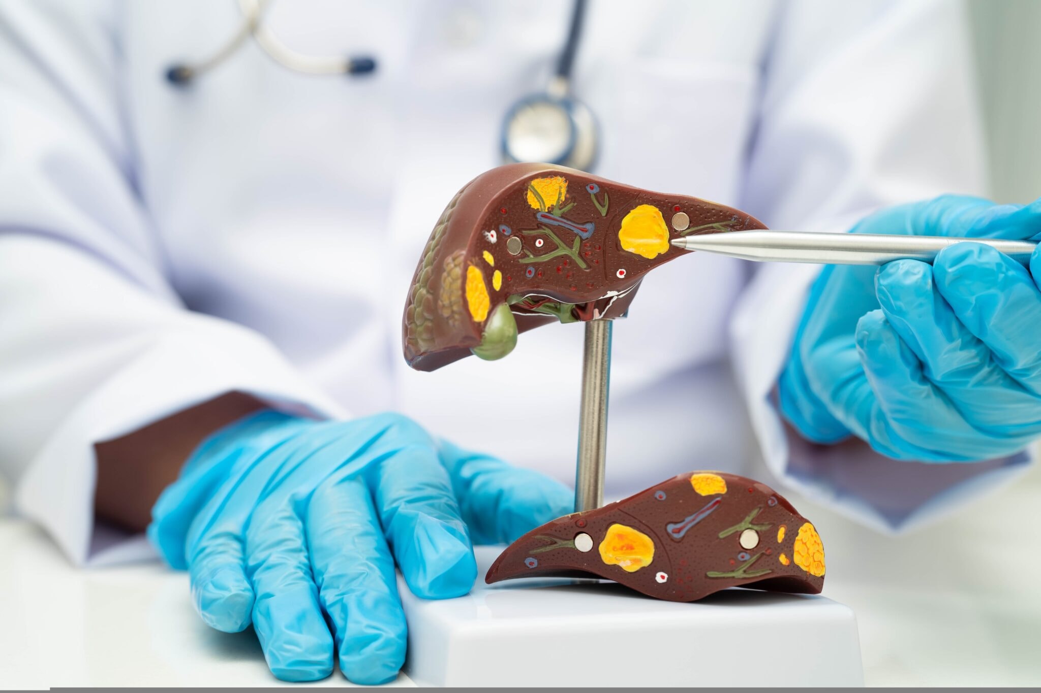 Cirrhosis,,Liver,Cancer,,Fatty,Liver,,Asian,Doctor,With,Liver,Human